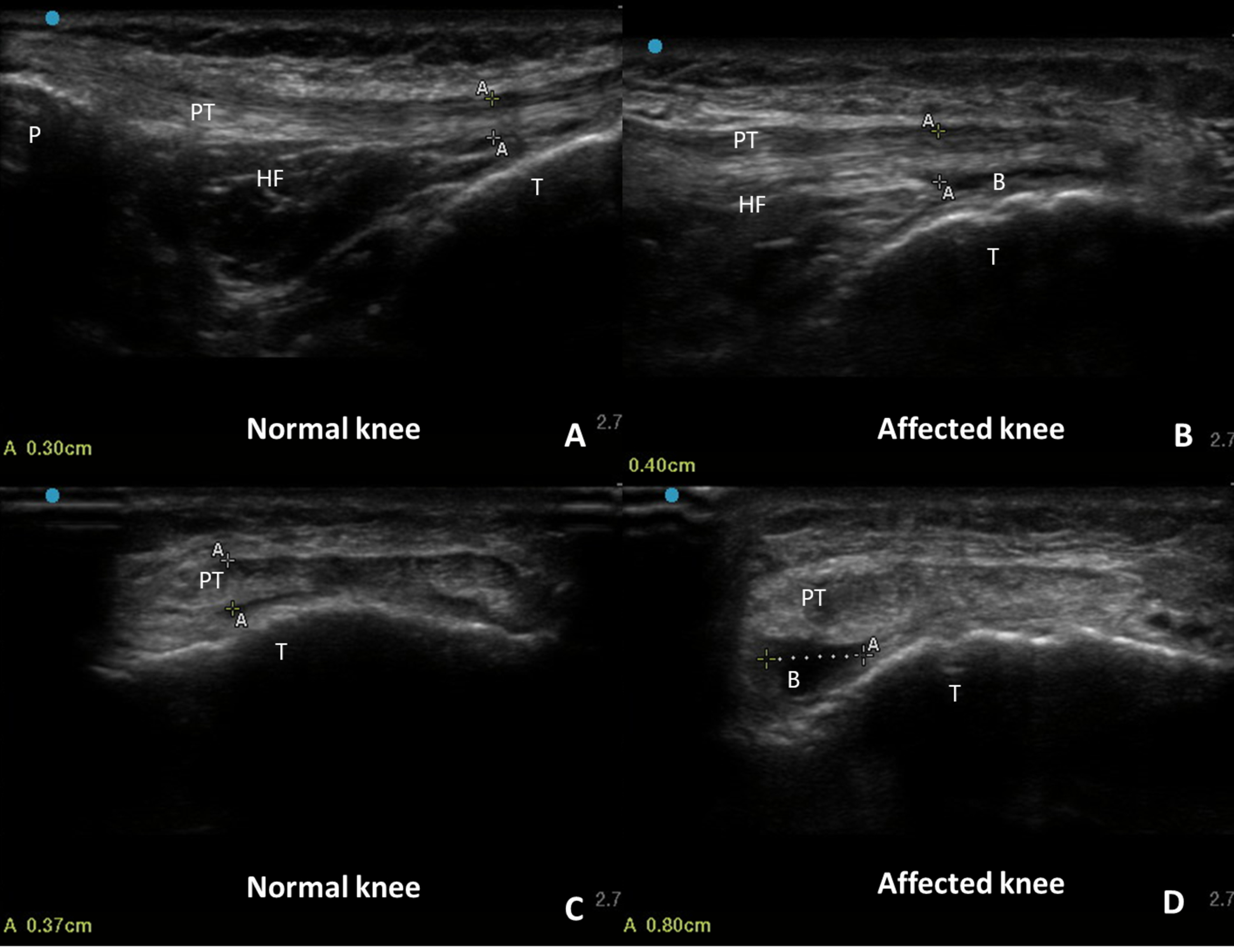 Cureus | A Case of Chronic Deep Infrapatellar Bursitis Complicated by ...