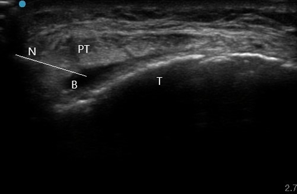 Cureus A Case Of Chronic Deep Infrapatellar Bursitis Complicated By