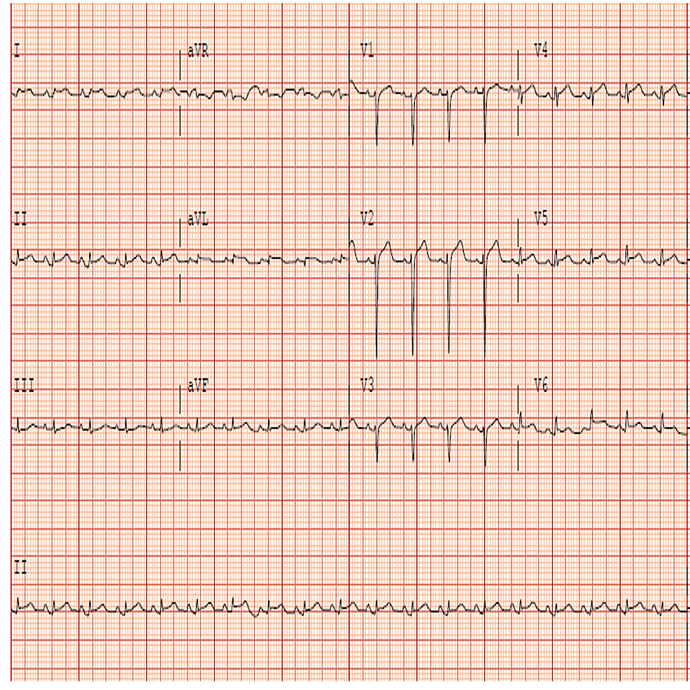 Cureus | Cardiogenic Shock: A Rare Complication of Influenza