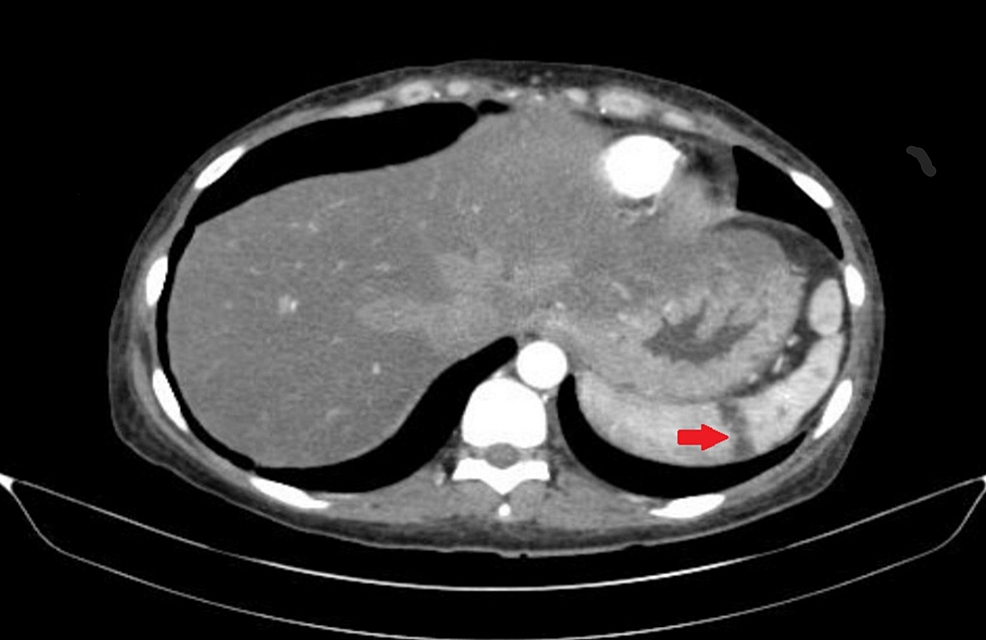 CT-abdomen-showing-wedge-shaped-splenic-infarct.