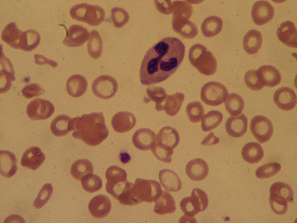 Peripheral-smear-showing-typical-features-of-iron-deficiency-anemia.