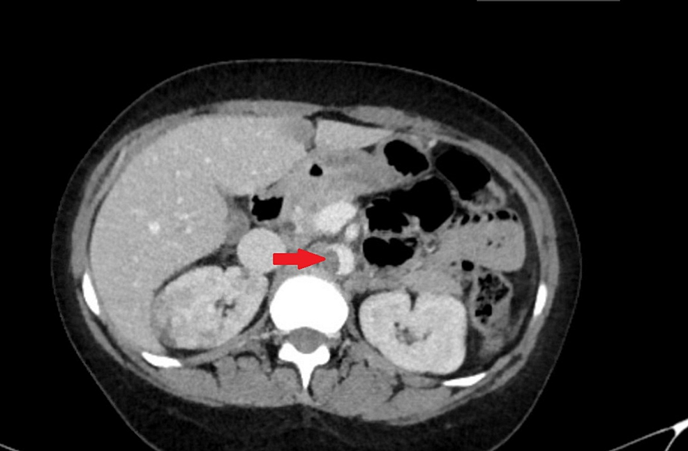 CT-abdomen-showing-thrombus-along-the-wall-of-abdominal-aorta.