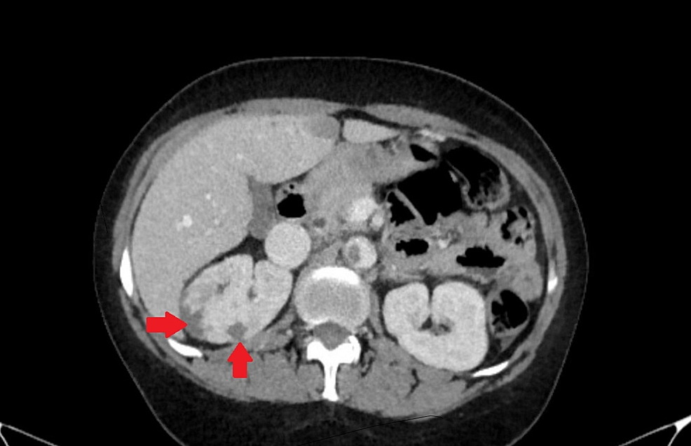 CT-abdomen-showing-wedge-shaped-hypodensities-in-right-kidney.