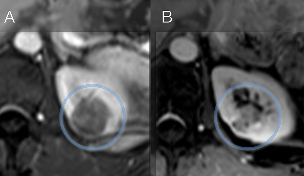 Result-of-RRS-therapy-in-a-patient-with-3.2cm-left-sided-RCC,-RENAL-Score-9:-(A)-baseline-and-(B)-at-one-year-follow-up.-Although-tumor-remains-detectable-on-imaging,-typical-cystic-transformation-can-be-seen-as-a-reaction-to-the-high-dose-radiation