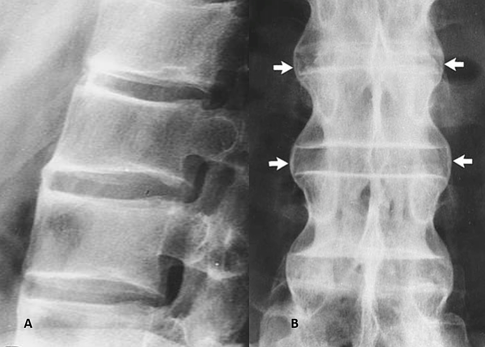 Cureus Signs of Nature in Spine Radiology