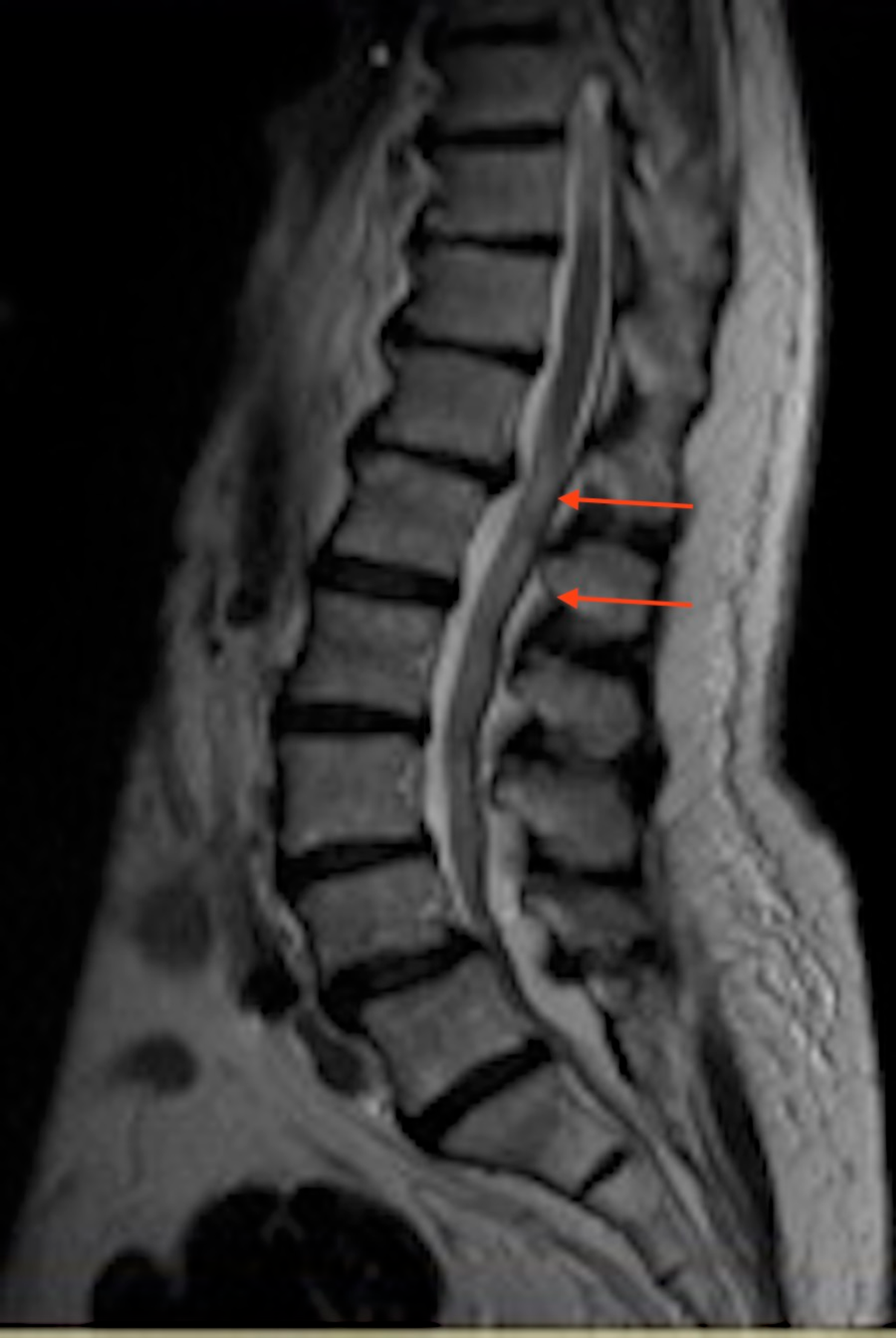 Cureus | Chronic Steroid Use Causing Spinal Epidural Lipomatosis