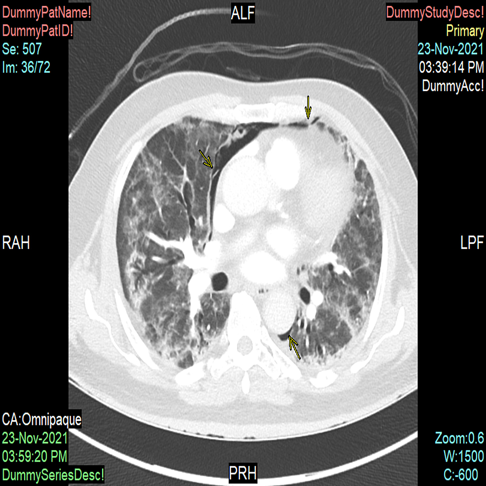Computed-tomography-scan-in-axial-view-of-the-patient-demonstrating-pneumomediastinum-(yellow-arrows-indicating-the-layering-of-air-alongside-pulmonary-vasculature)