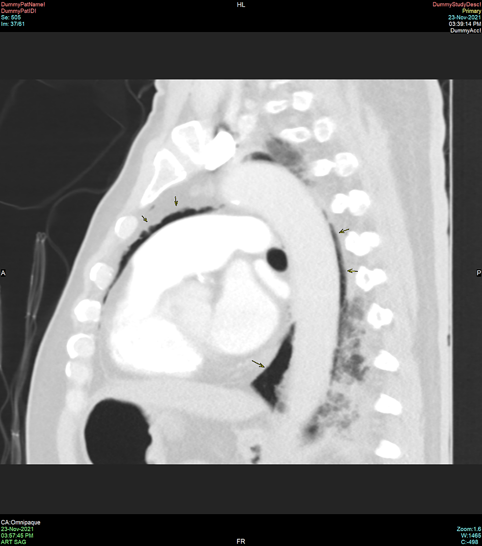 Sagittal-view-of-a-computed-tomography-scan-of-the-thorax-demonstrating-pneumomediastinum-(black-arrows)