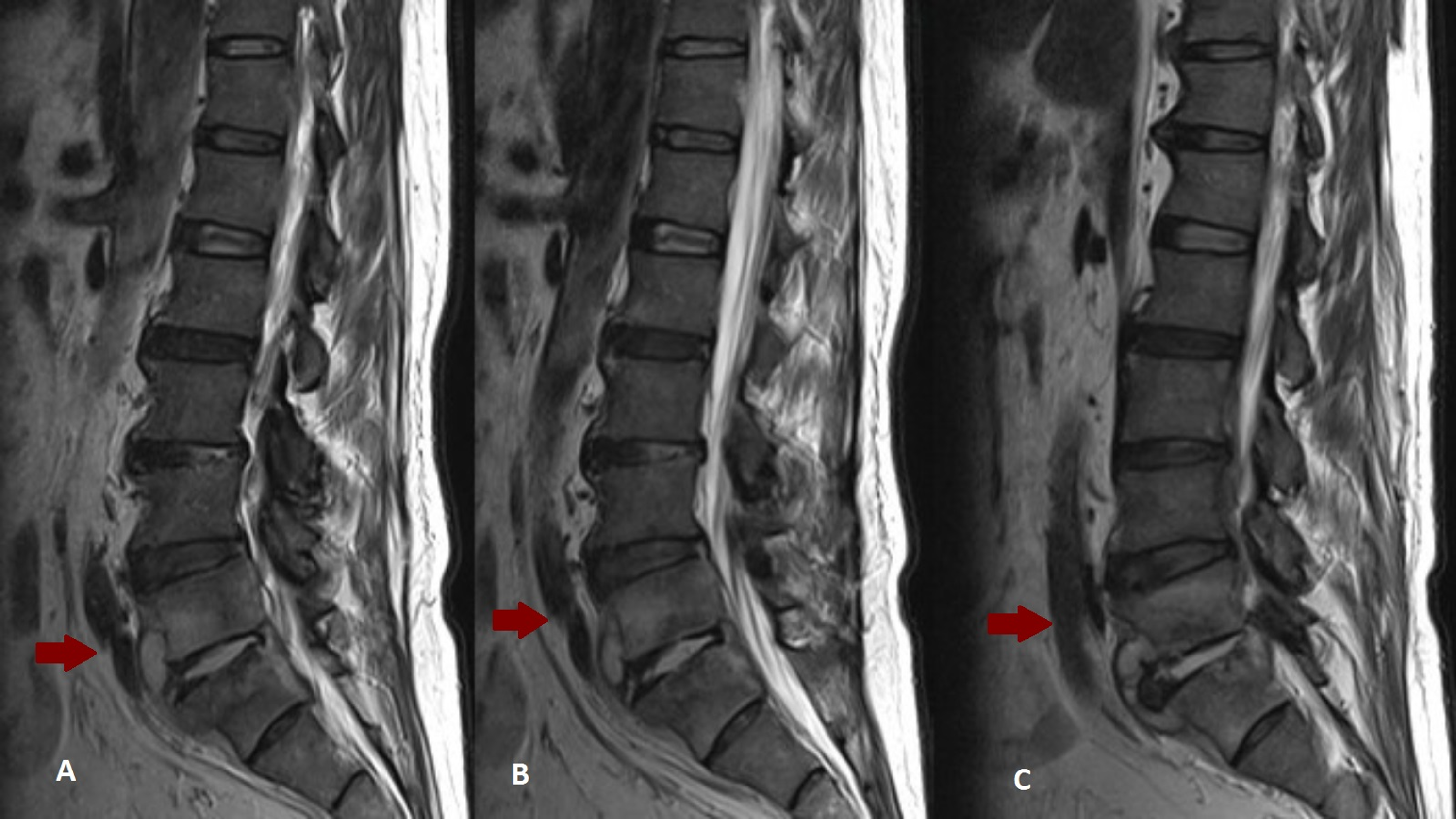 Cureus | Is It Back Pain or Pott’s Disease?