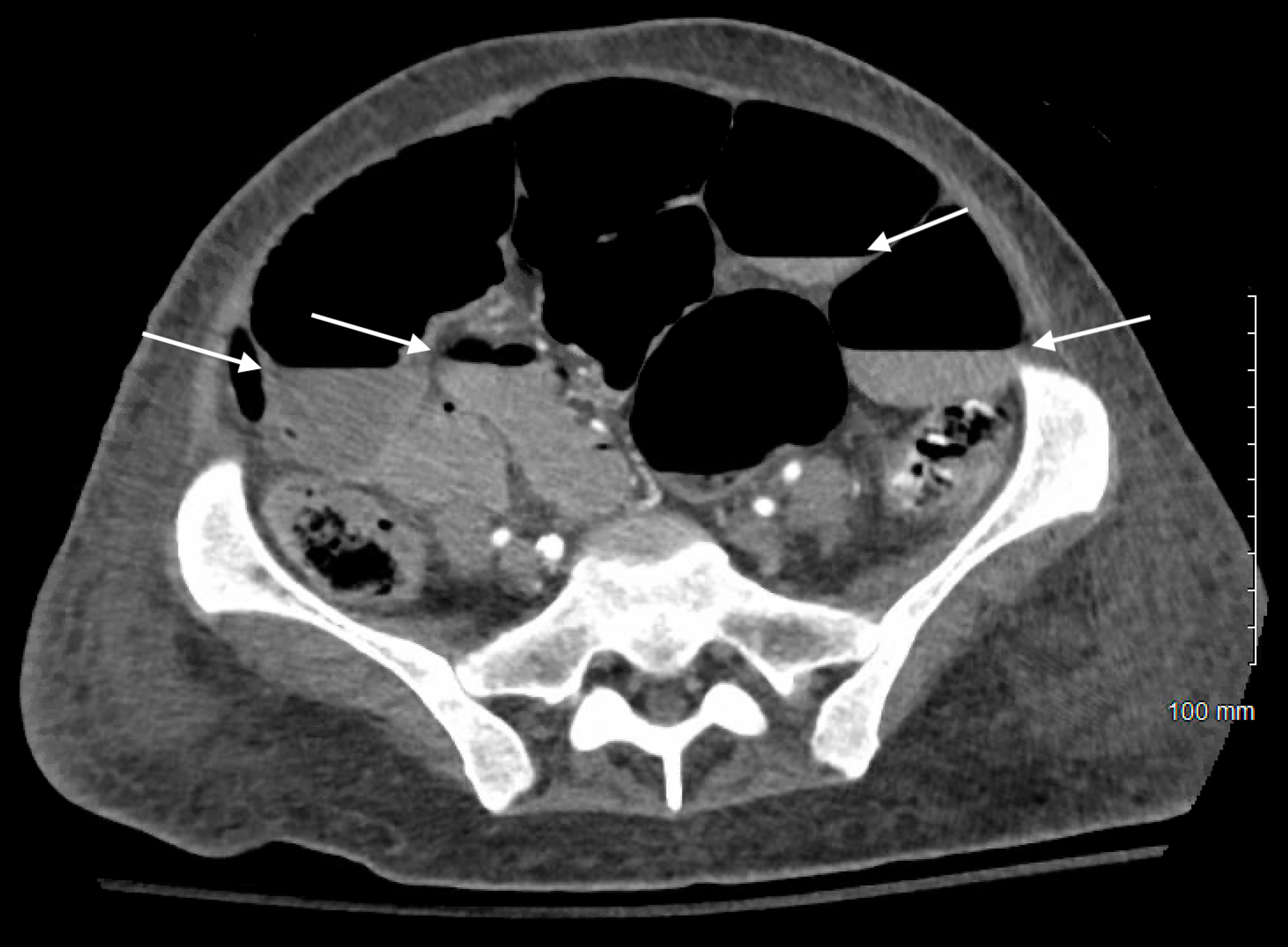 Cureus Systemic Sclerosis, Malnutrition, and Small Bowel Obstruction