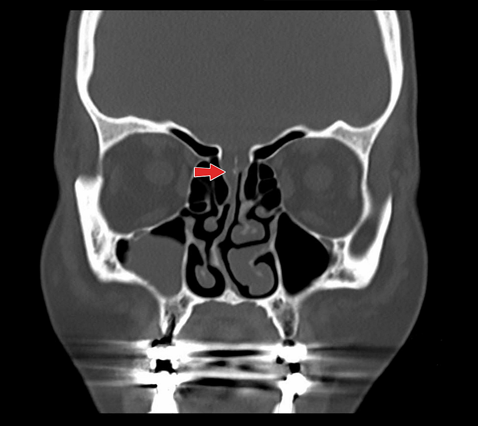 Cureus Spontaneous Cerebro Spinal Fluid Rhinorrhoea Caused By 