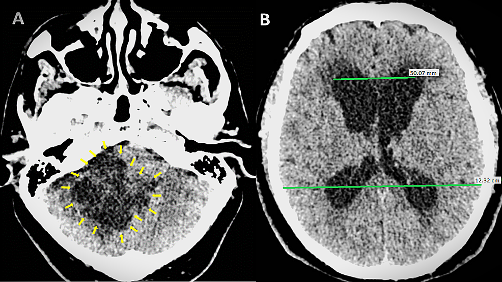 Double intraspinal enterogenous cysts.