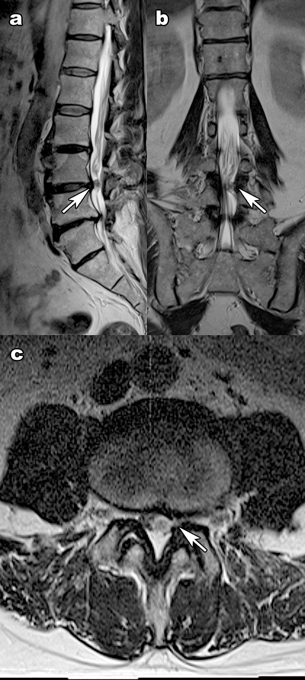 Cureus Intradural Lumbar Disc Herniation From The Lateral Inner Surface Of The Dura Without A