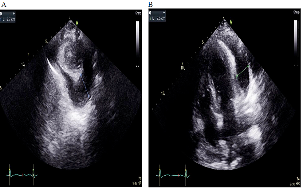 Parasternal-short-axis-window-(A)-and-apical-4-chamber-window-show-large-pericardial-effusion-(B).