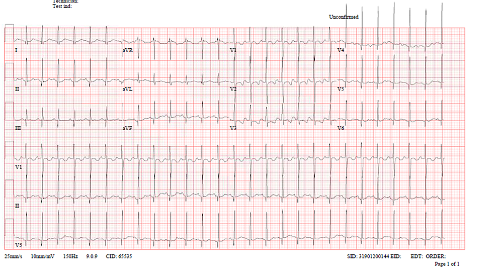 Cureus | Salbutamol-Induced QT Interval Prolongation in a Two-Year-Old ...