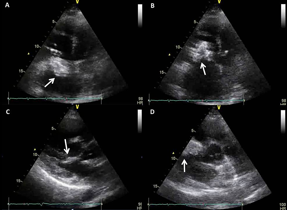 findings-on-transthoracic-echocardiography.