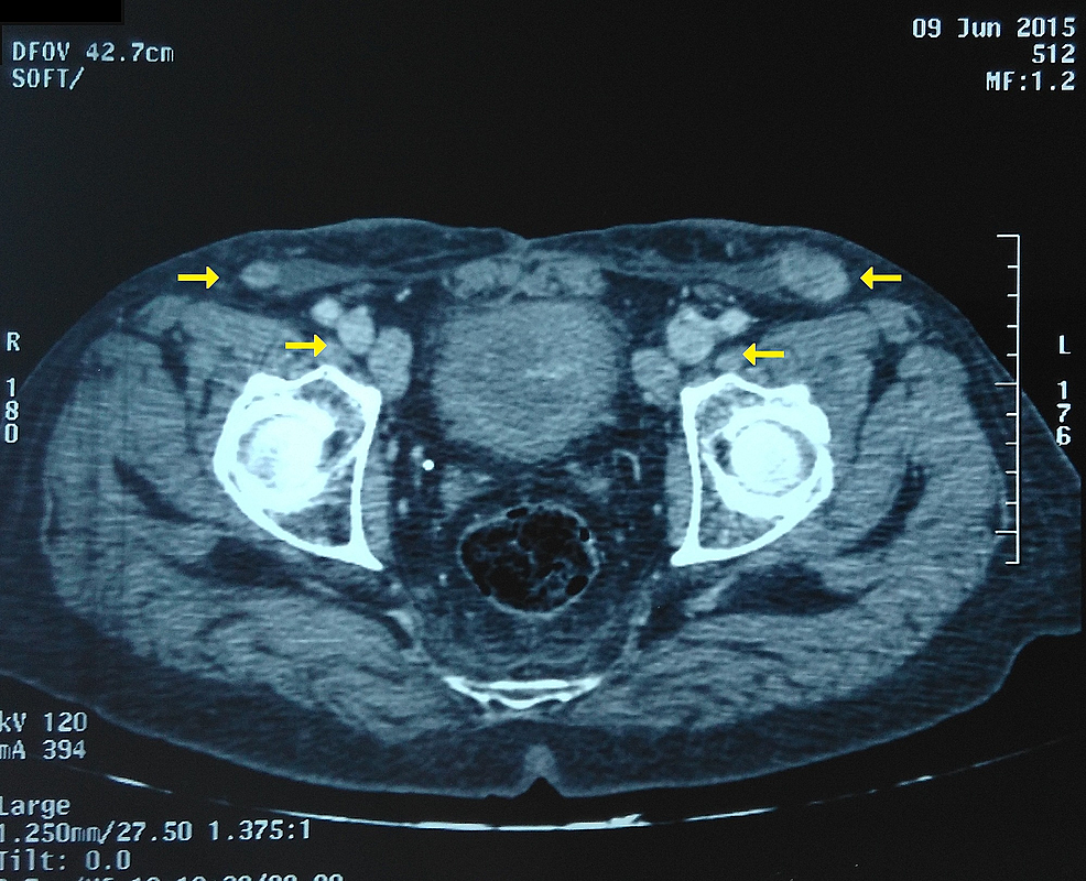 Ct Scan Showing The Metastatic Inguinal Lymph Node Sexiezpix Web Porn 