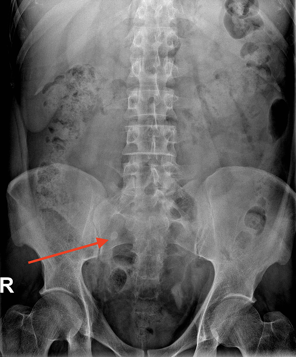 Cureus A Case of Stump Appendicitis Secondary to Appendicular Fecolith