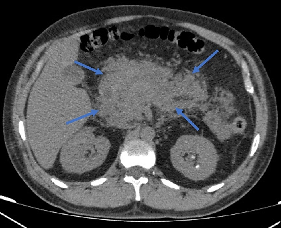 Abdomen-CT-demonstrating-diffuse-enlargement-of-pancreas-with-ill-defined-borders-(arrows)