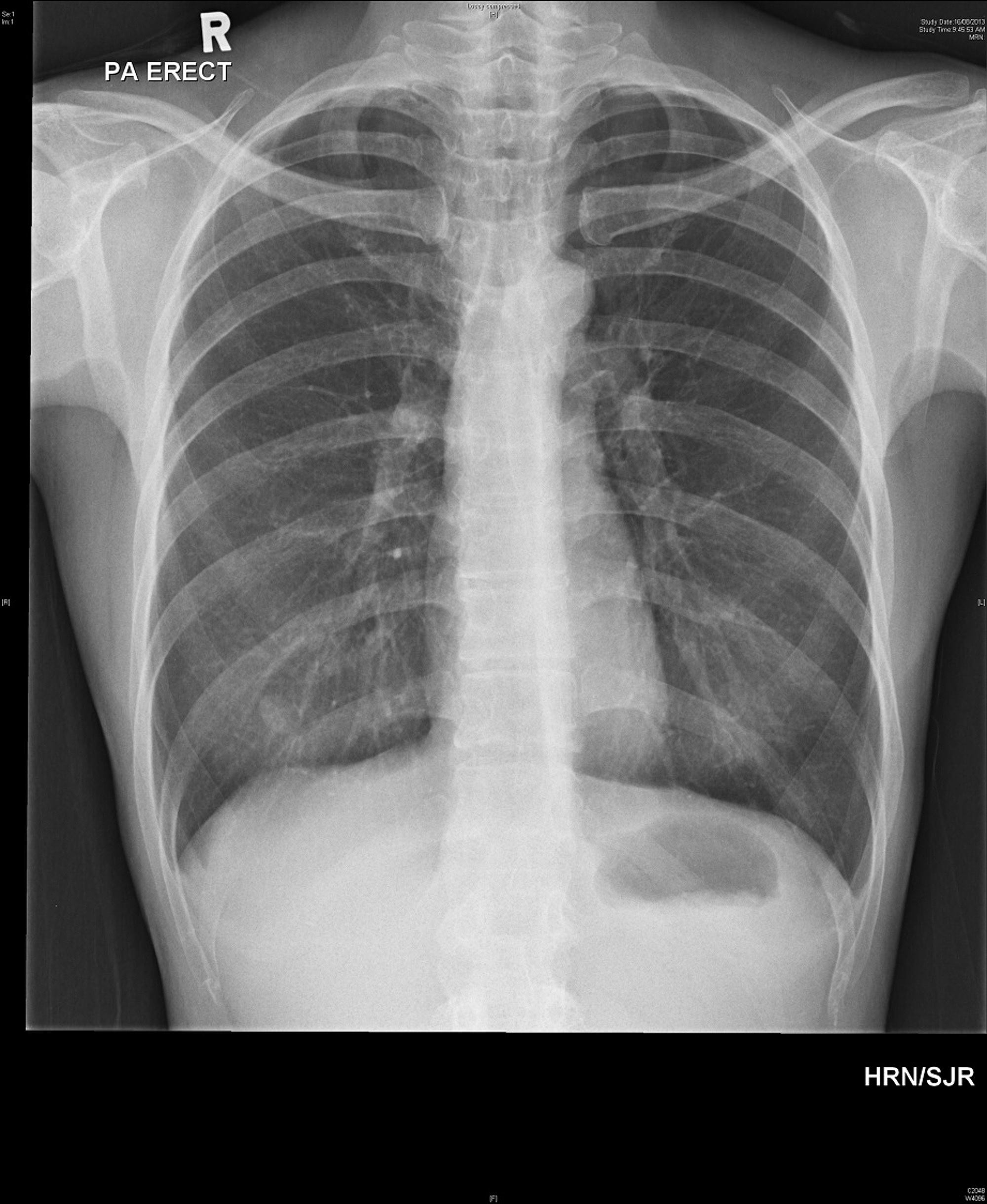 Cureus | Traumatic Pneumothorax Secondary to Acupuncture ...