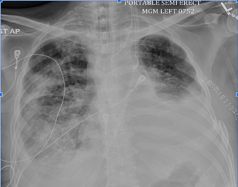 A Case of Bilateral Hemorrhagic Pleural Effusion Due to Dual ...