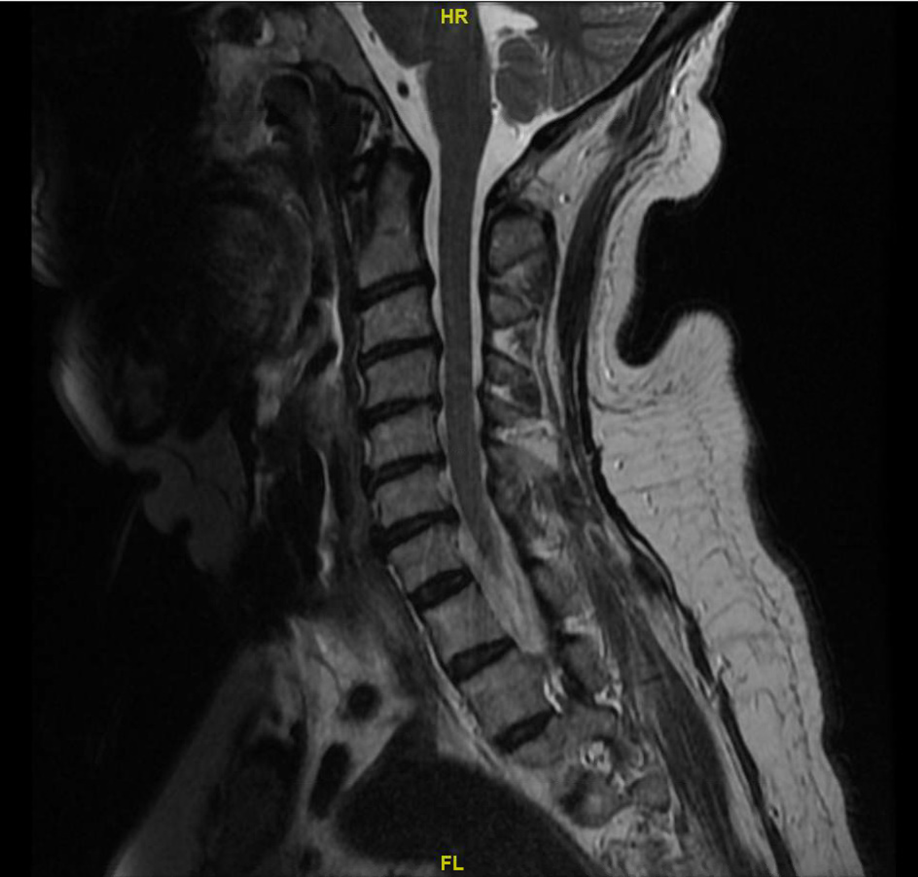 Cureus | COVID-19-Associated Autoimmune Disease: A Rare First Case ...