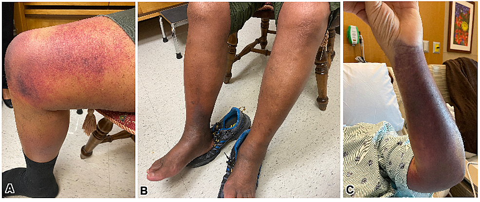 Spontaneous-ecchymosis-involving-right-thigh-(A),-and-right-ankle-(B)-rendering-the-leg-double-the-normal-circumference.-Left-upper-extremity-ecchymosis-had-spontaneously-developed-despite-immunosuppressive-treatment-(C).