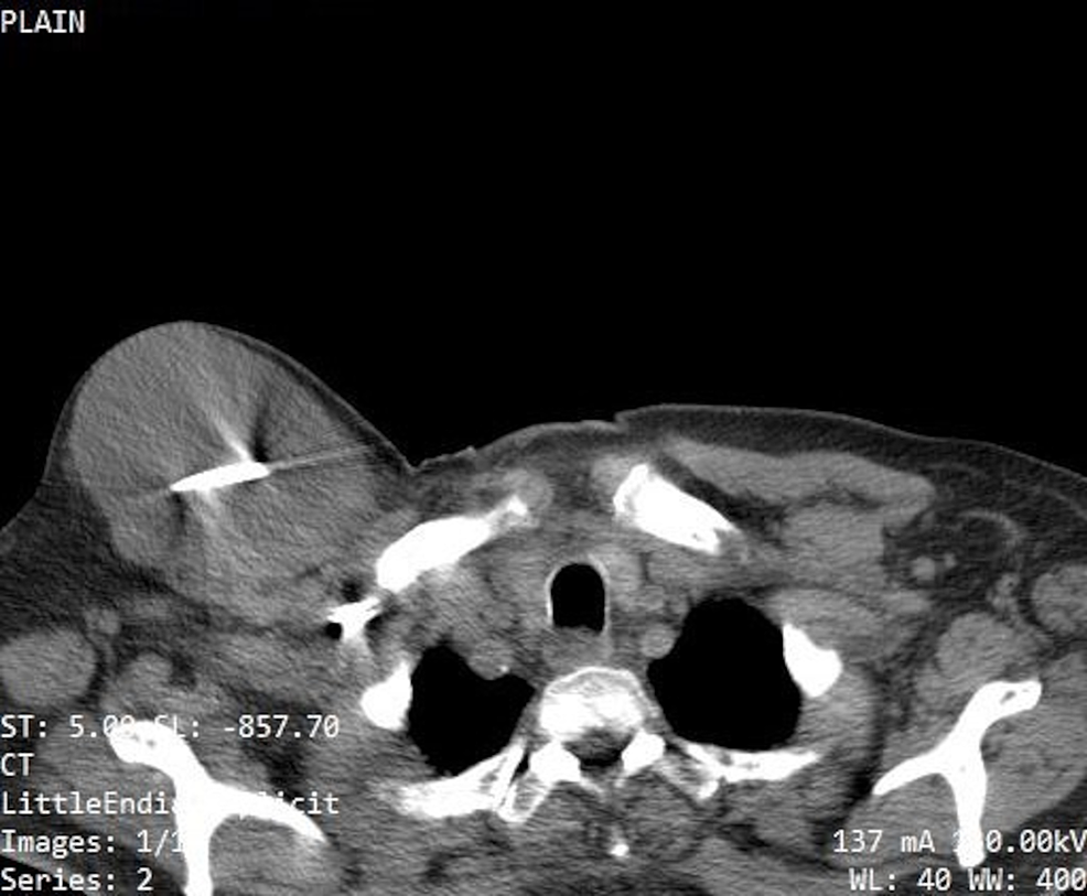 Cureus A Case of Delayed Noninfective Cystic Swelling at the