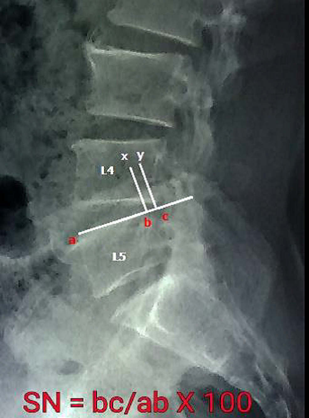 Lumbar Instability
