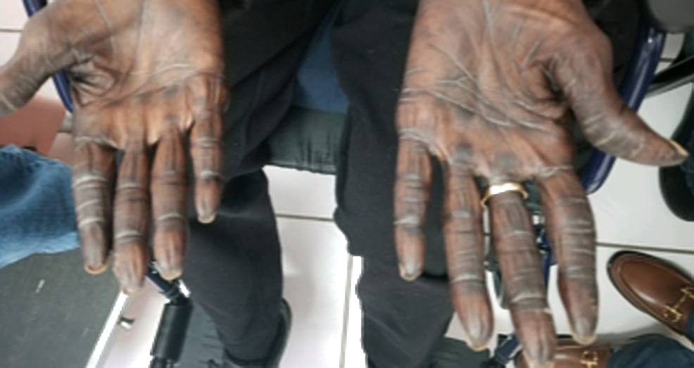 Cureus Hyperpigmentation with Capecitabine Part of HandFoot