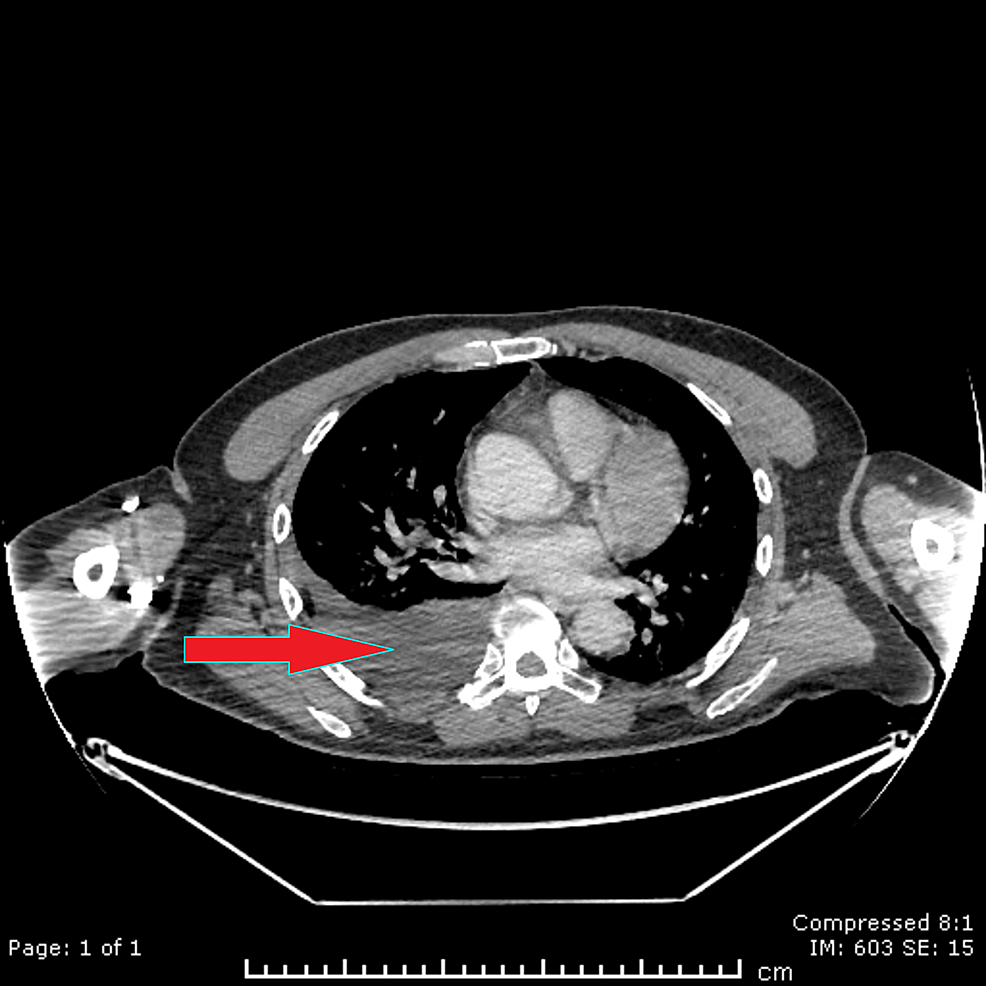Right-sided-pleural-effusion-clearly-seen-on-axial-imaging