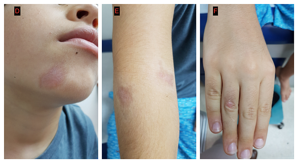 D-F.-Improvement-of-cutaneous-lesions-after-treatment-with-pentavalent-antimonial-(Glucantime-©).