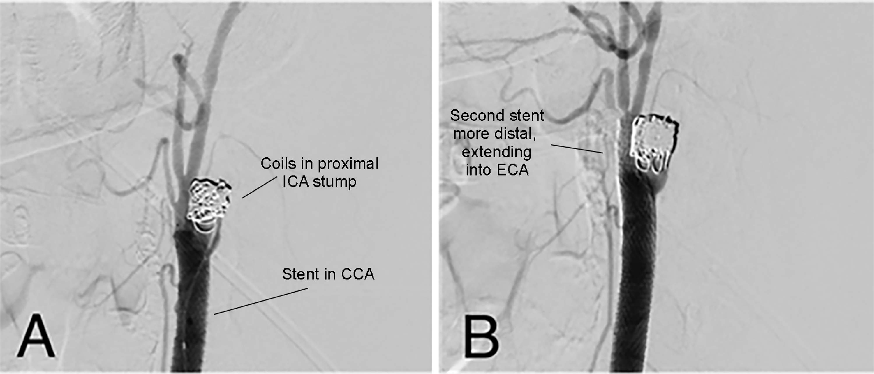 Carotid Stump Syndrome With StentAssisted Coil Embolization Cureus