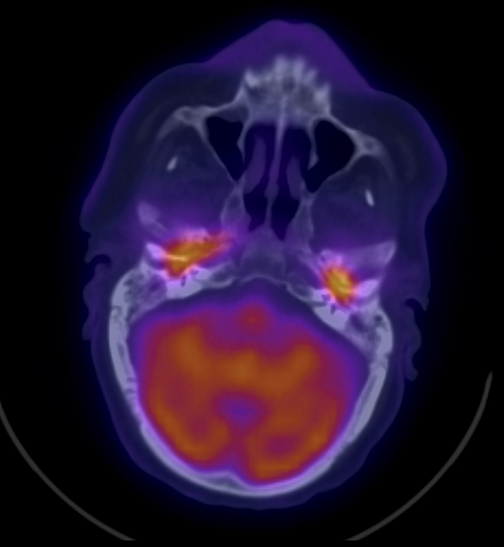 Fused-transaxial-F-18-FDG-PET/CT-showing-bilateral-hypermetabolic-involvement-of-both-middle-ears-without-direct-extension-from-one-side-to-the-other-through-the-skull-base-structures