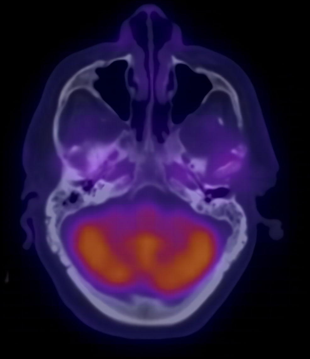 Follow-up-fused-transaxial-F-18-FDG-PET/CT-after-six-months-of-antimicrobial-treatment-showing-resolution-of-abnormal-FDG-uptake-of-both-middle-ears