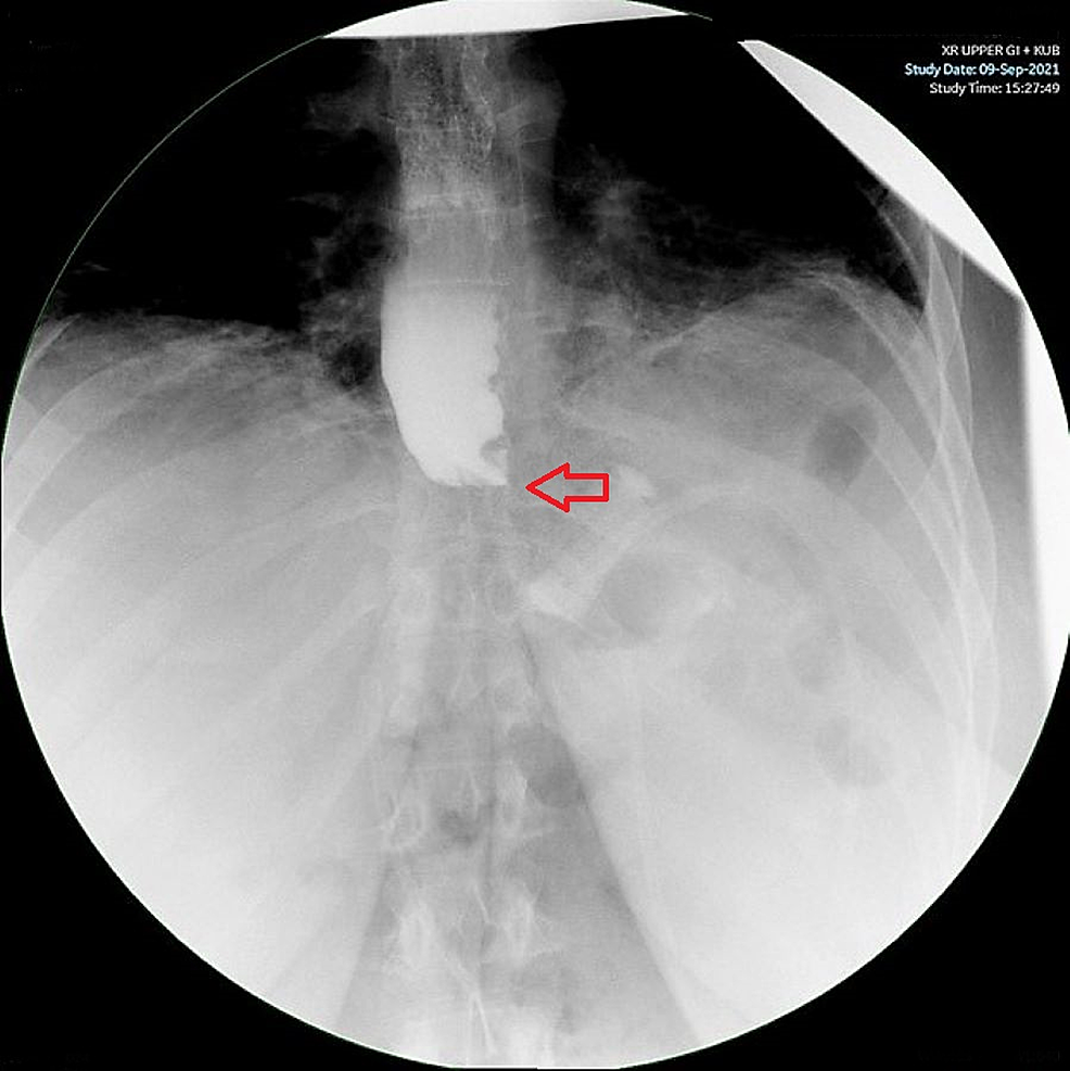 Upper GI X-ray showing contrast retention, indicating good gastric band function and no leak (red arrow)