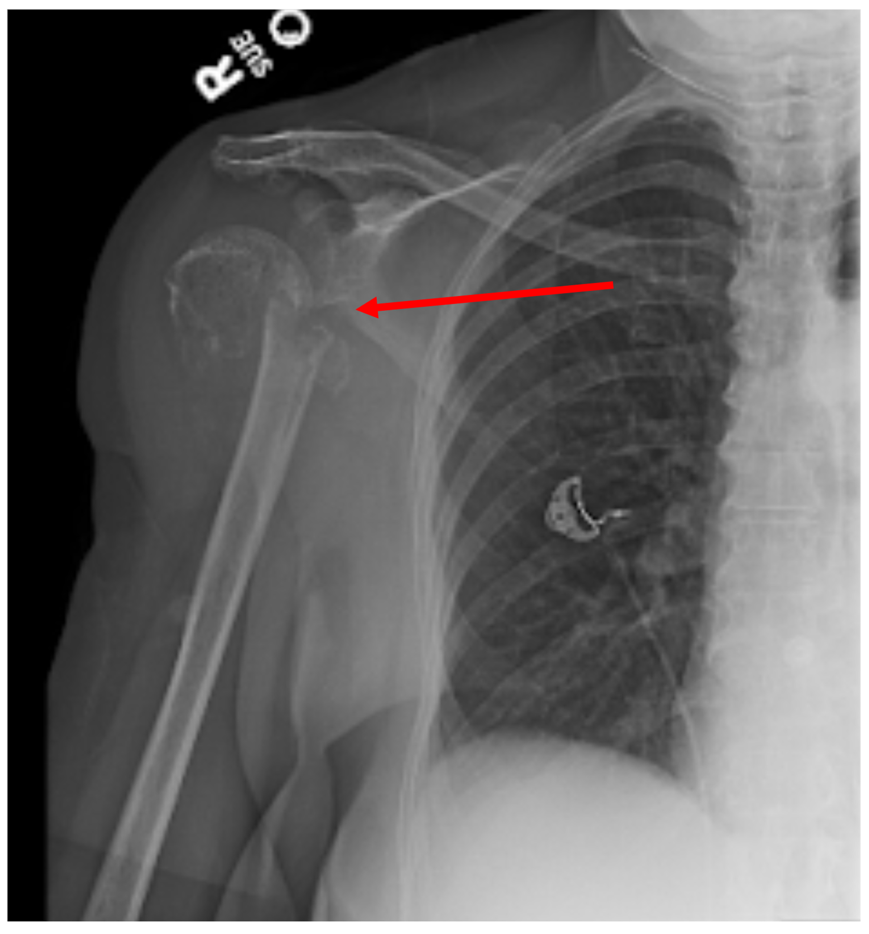 Cureus An Unusual Presentation of Multiple Myeloma A 71YearOld