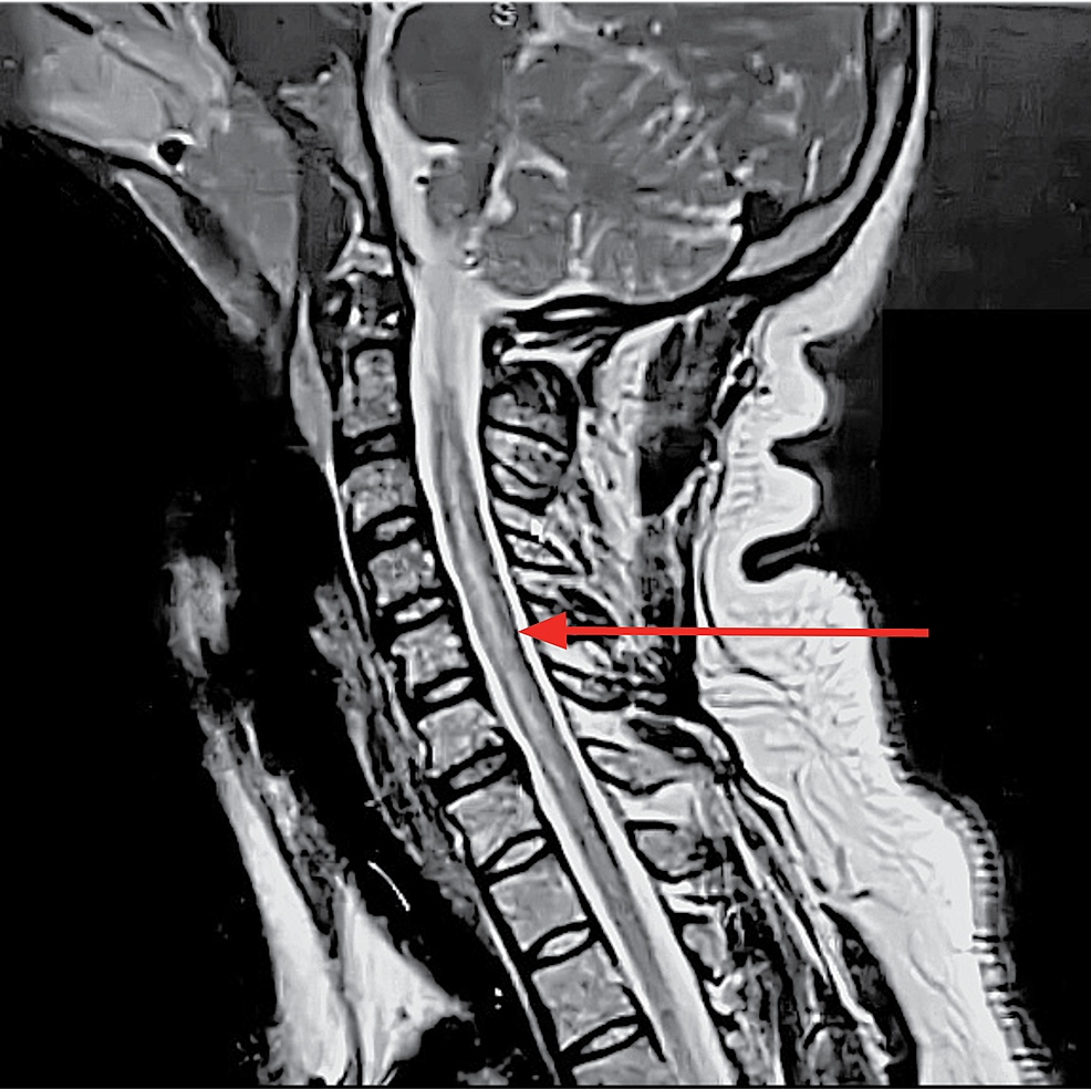 Sagittal,-T2-weighted-MRI-of-the-cervical-spine