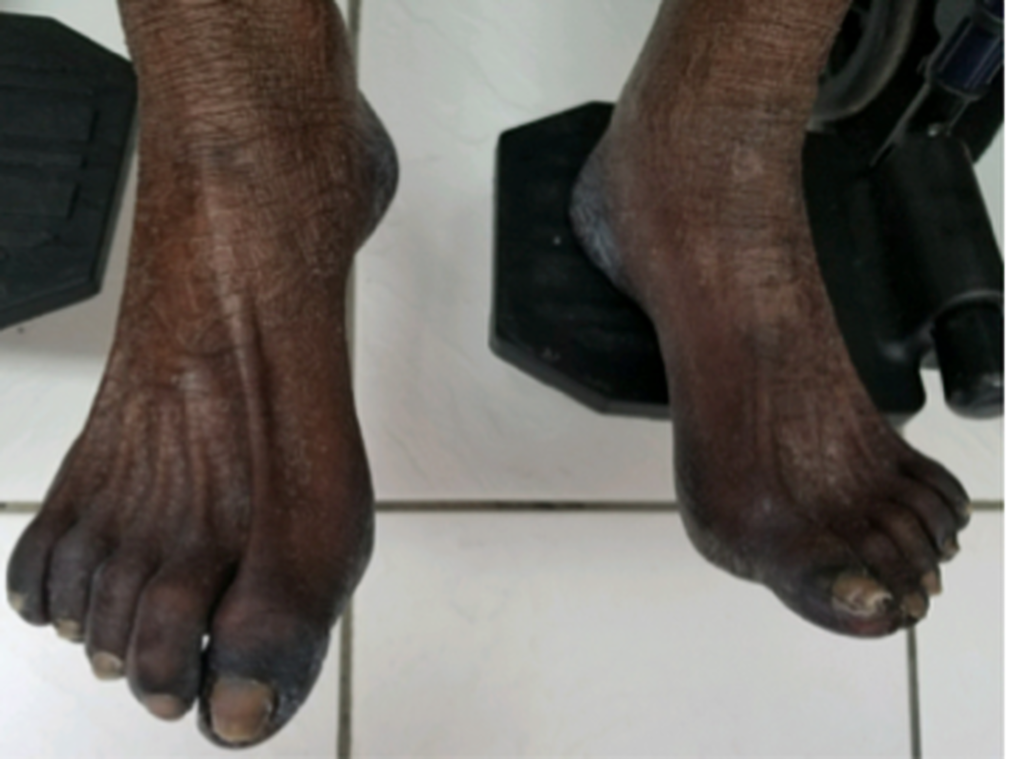 cureus-hyperpigmentation-with-capecitabine-part-of-hand-foot