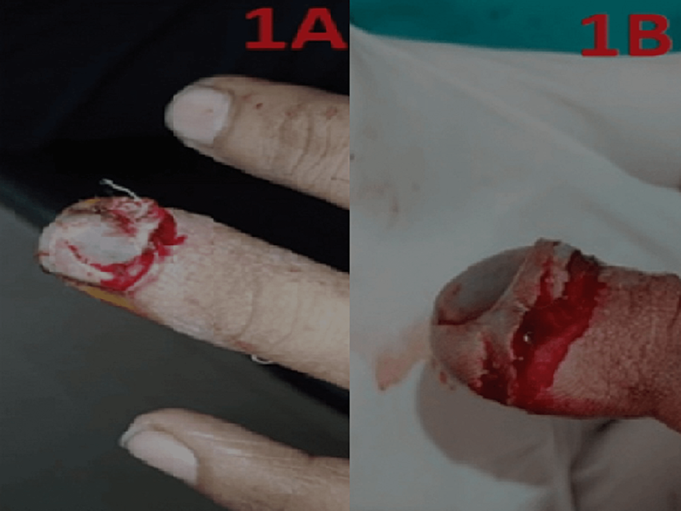 What is a Finger Fracture & How to Handle Such Injuries? - Upswing