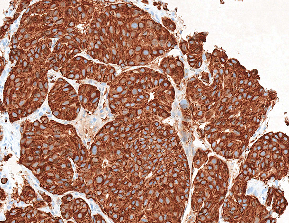 In-immunohistochemical-studies,--the-neoplastic-cells-are-strongly-positive-for-chromogranin