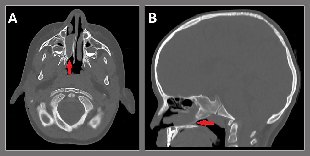 CT-landmark-sinus-protocol-without-contrast-(A:-axial-plane;-B:-sagittal-plane).