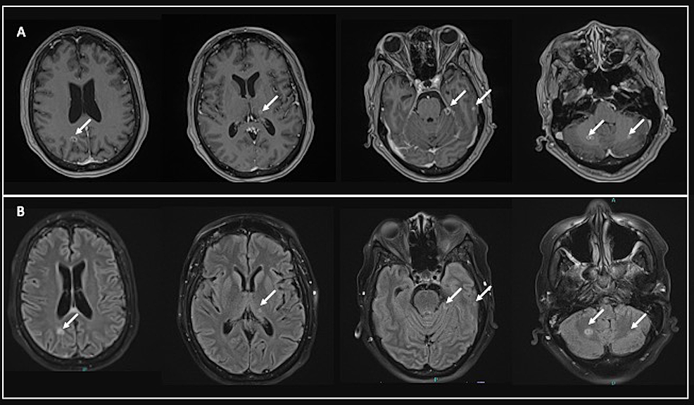 MRI-of-the-brain-with-and-without-contrast.