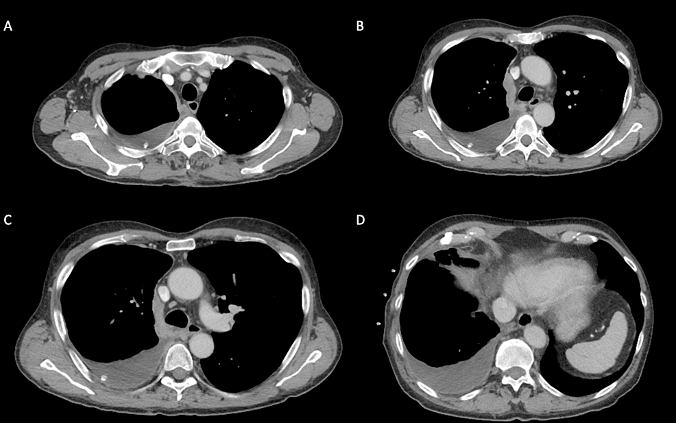 CT-Chest-at-time-of-diagnosis,-after-pleural-effusion-drainage.-A)-Pleural-based-disease-along-superior-aspect-of-mediastinum-measuring-thickness-of-12-mm.-B)-Pleural-based-conglomerate-abutting-lateral-superior-mediastinum,-measuring-up-to-17-mm-in-thickness.-C)-Pleural-based-plaque-extending-down-mediastinum.-D)-Pleural-effusion-at-right-lung-base.-