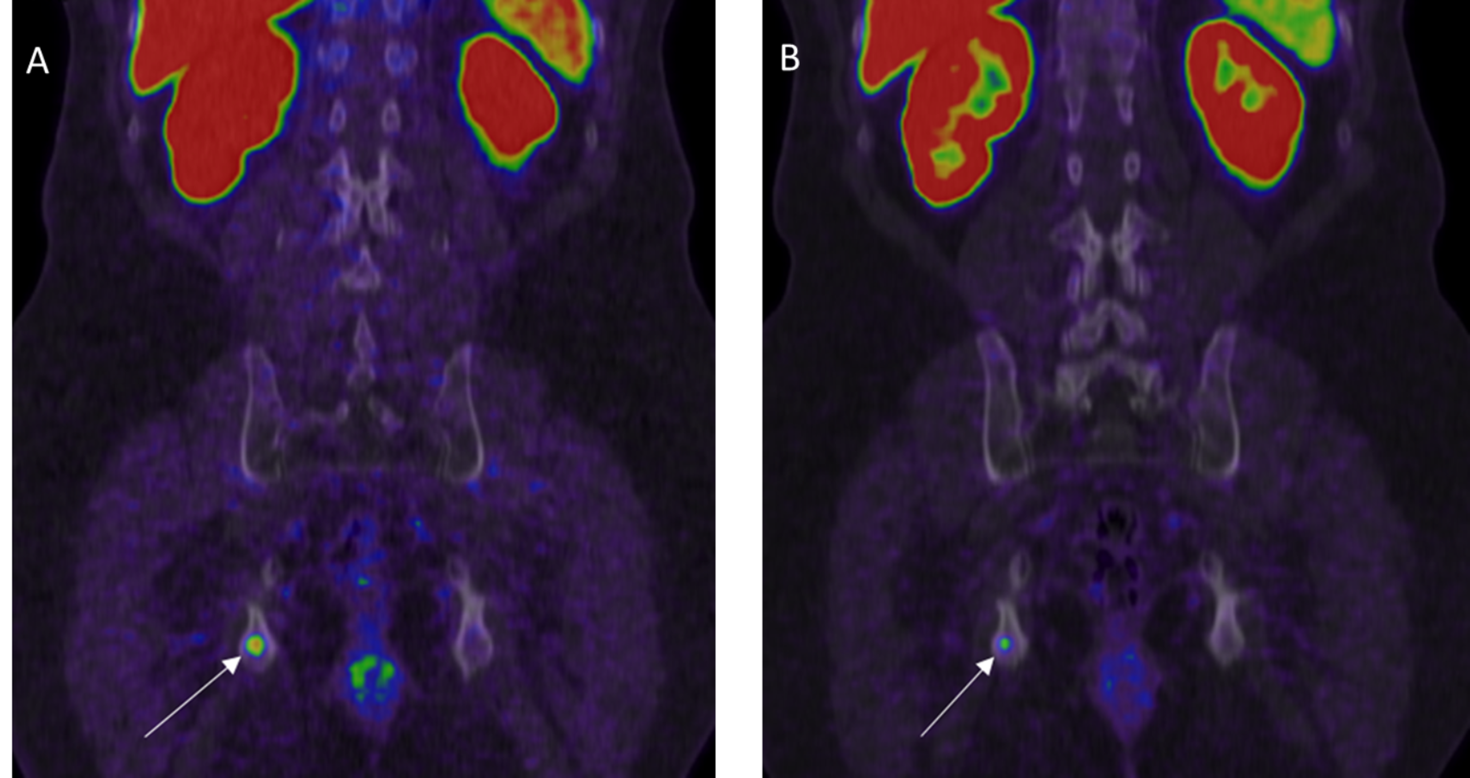 Cureus | Gallium-68 Prostate-Specific Membrane Antigen Positron Emission  Tomography: A Practical Guide for Radiologists and Clinicians | Article