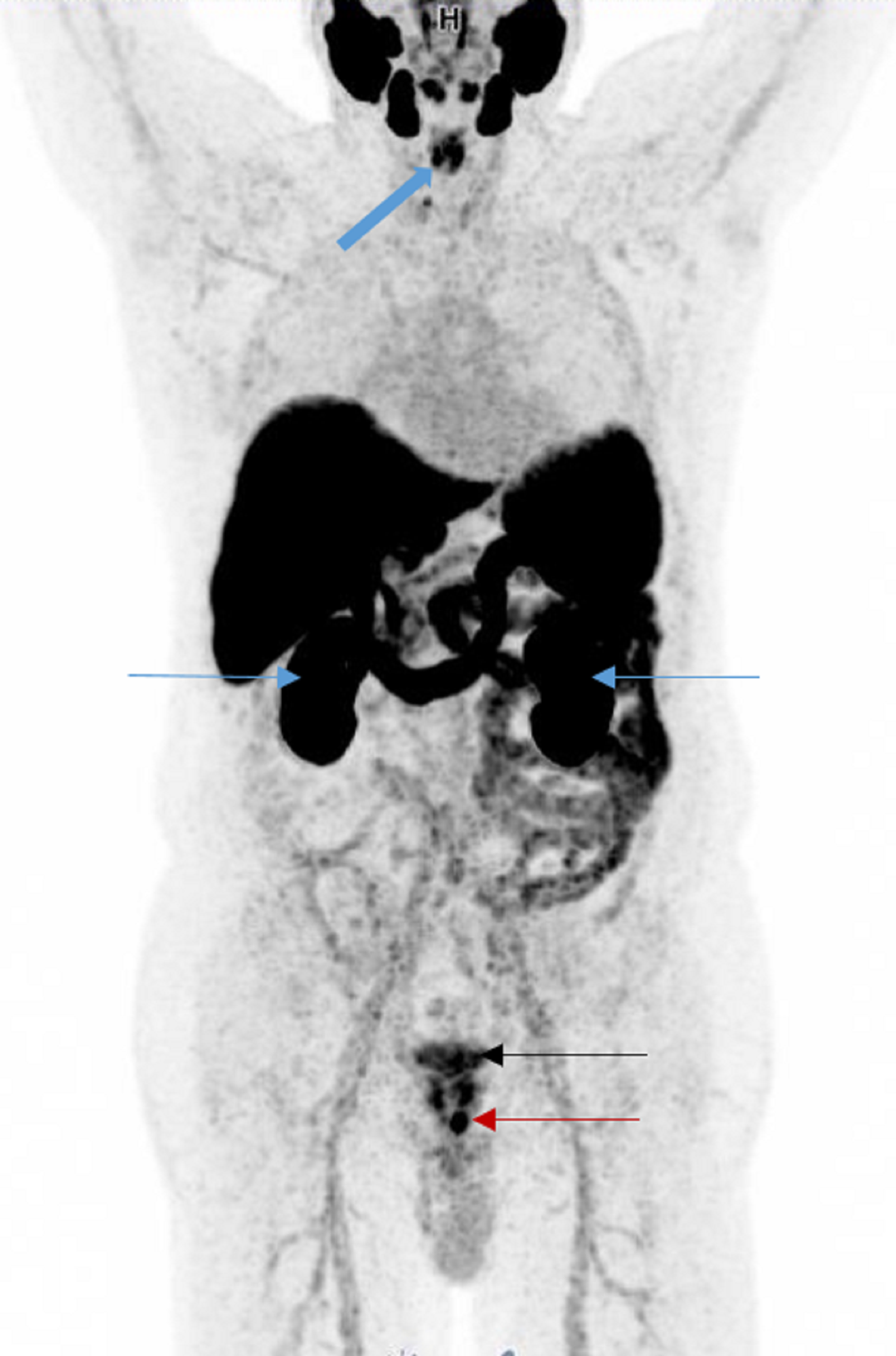 Cureus | Gallium-68 Prostate-Specific Membrane Antigen Positron ...