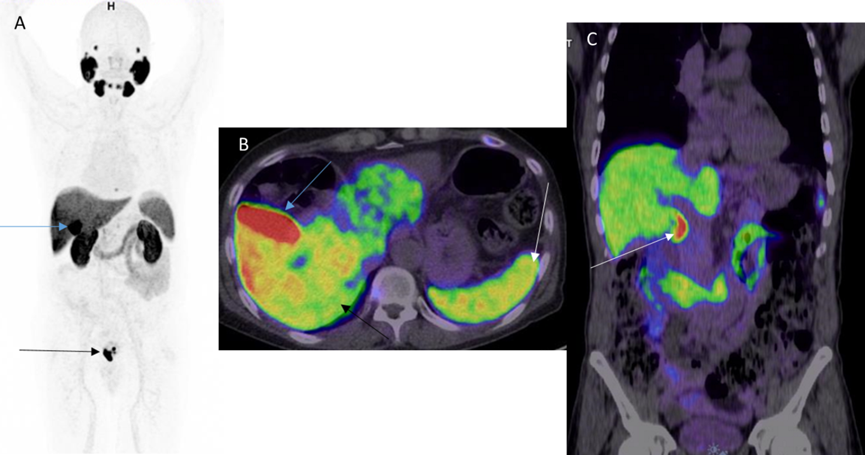 Cureus | Gallium-68 Prostate-Specific Membrane Antigen Positron ...