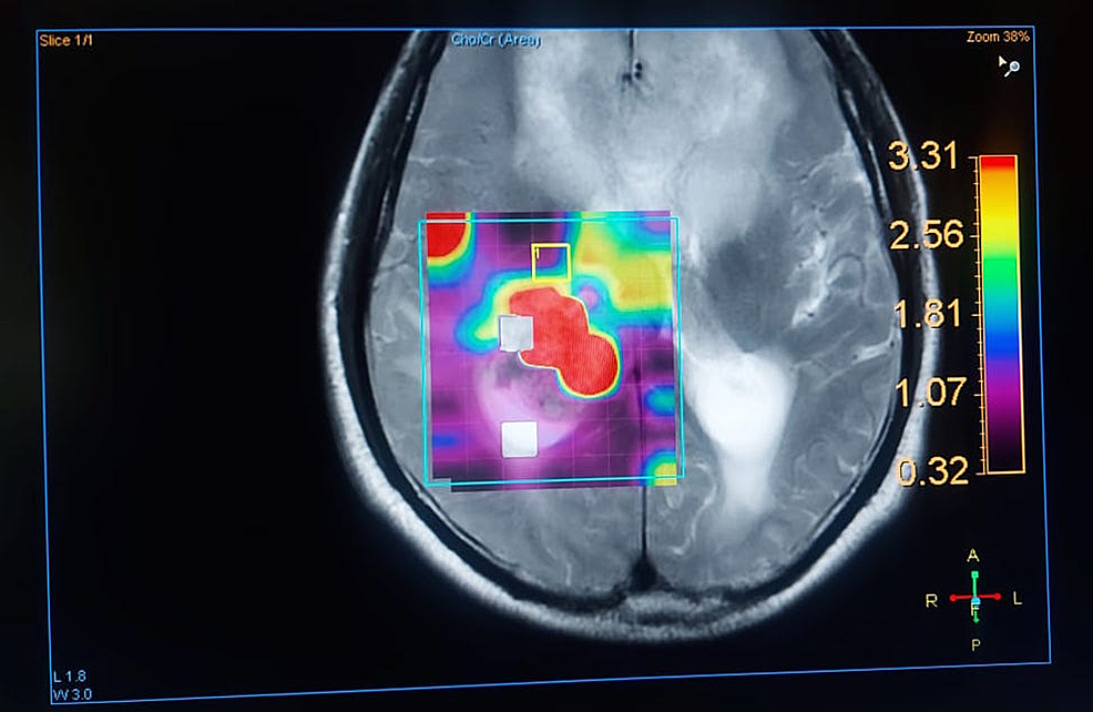 Cureus Diagnostic Accuracy of Magnetic Resonance Spectroscopy in