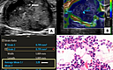 Cureus Role Of Sonoelastography In Differentiating Benign From Malignant Cervical Lymph Nodes