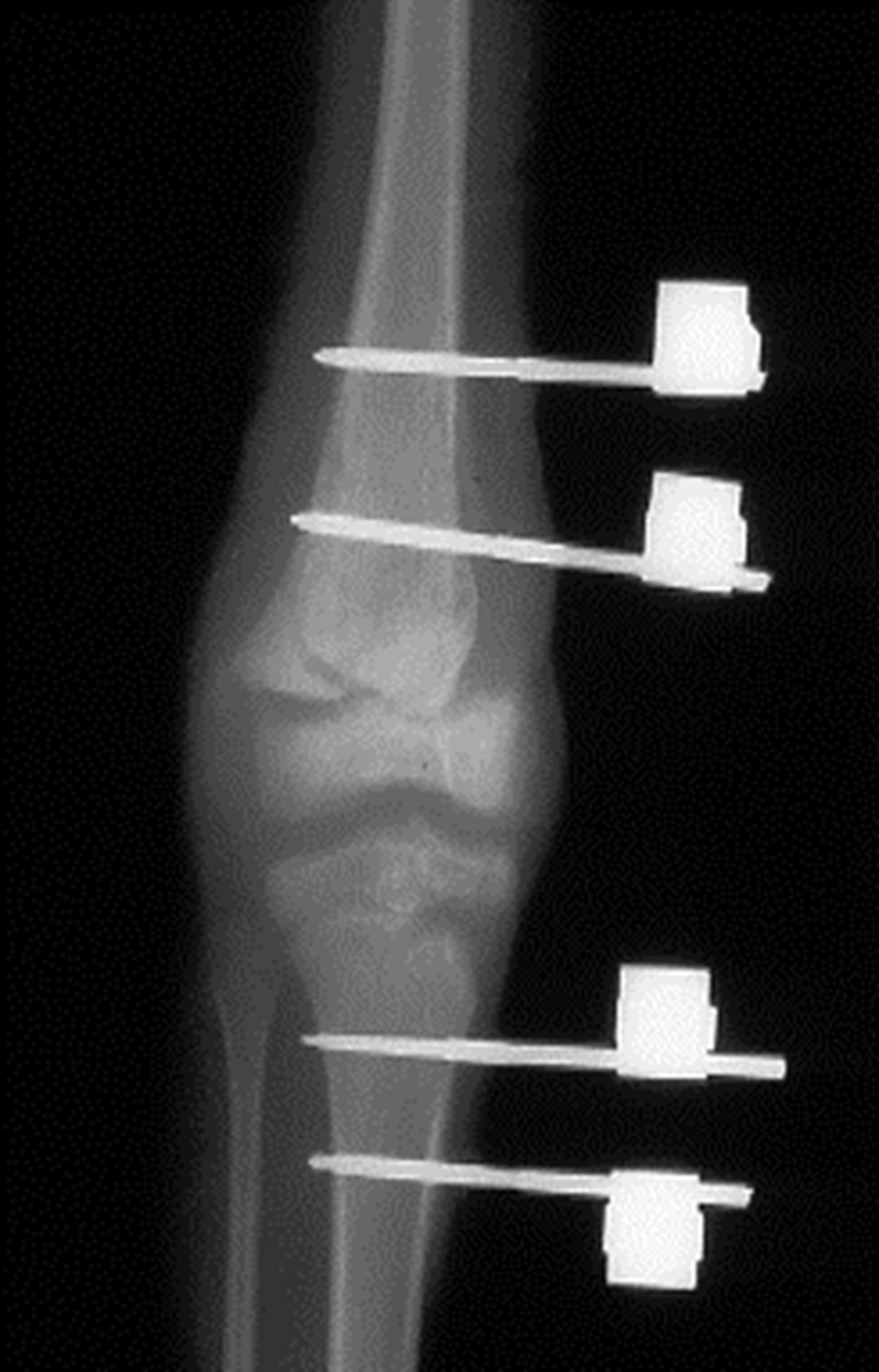 Cureus Spanning External Fixation for the Treatment of Open Joint